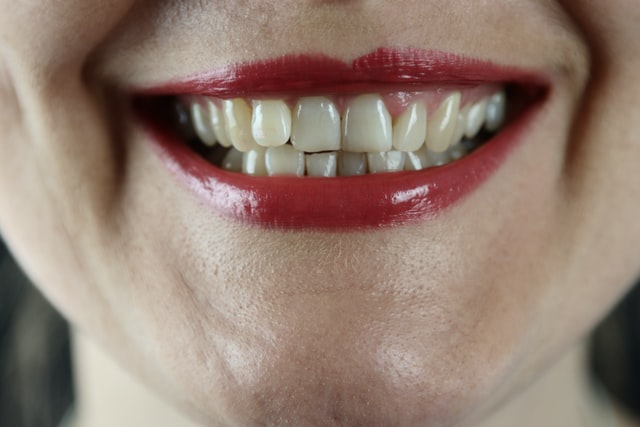 How To Fill Gap Between Teeth Naturally At Home