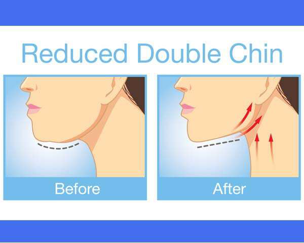 Get Rid of a Double Chin